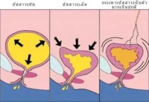 Urotex รีวิว